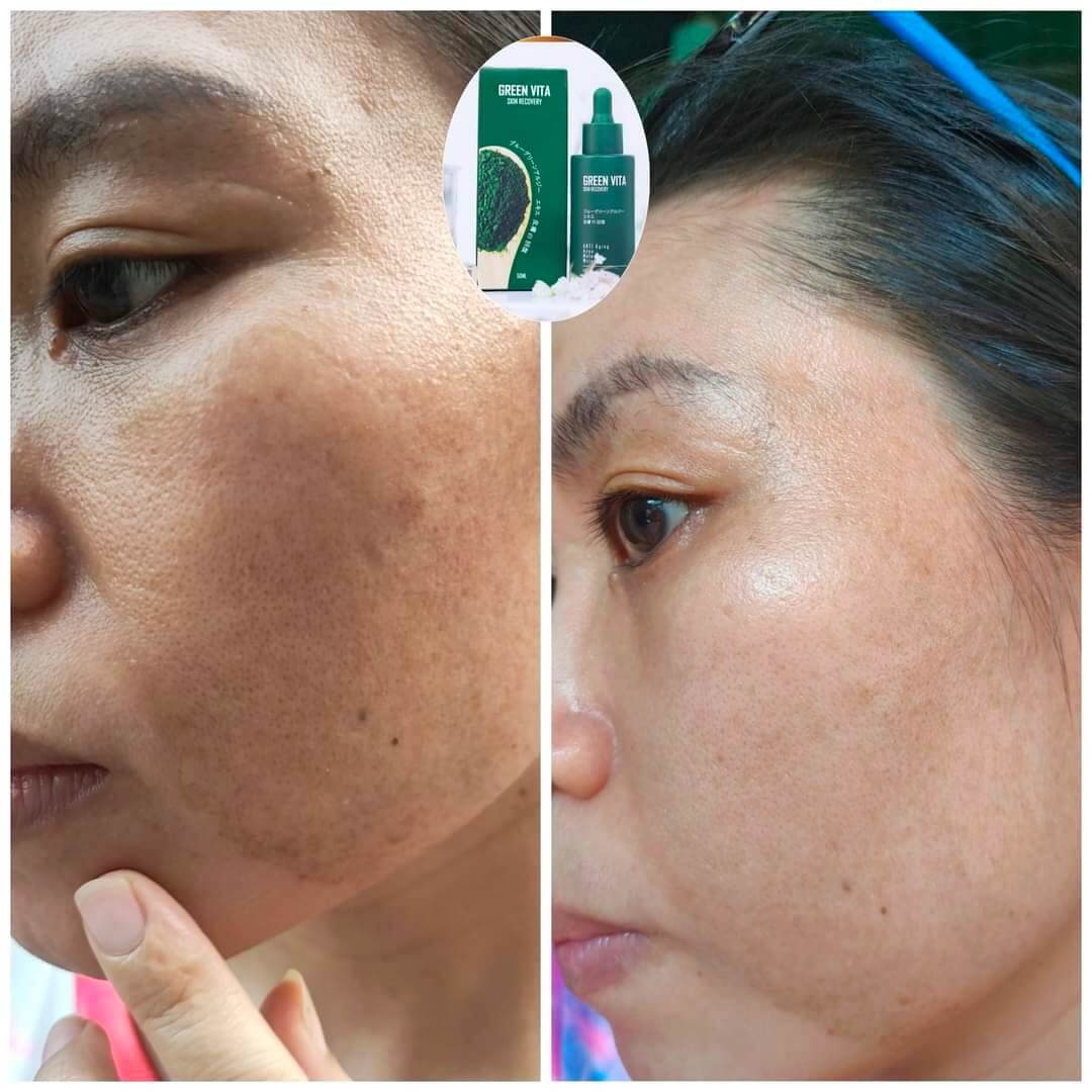 Serum Green Vita siêu vi tảo hình 30